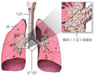 Nature：发现一个新的肺鳞癌治疗靶点