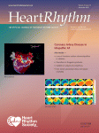 Heart Rhythm:心脏再<font color="red">同步化</font><font color="red">治疗</font>远期死亡率变异颇大