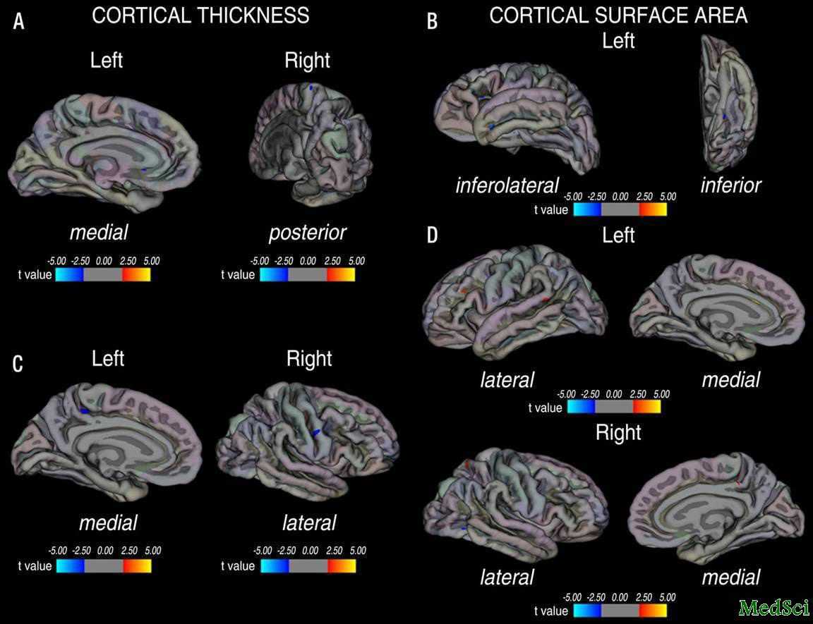 Radiology:MRI显示偏头痛患者<font color="red">大脑</font>皮质异常