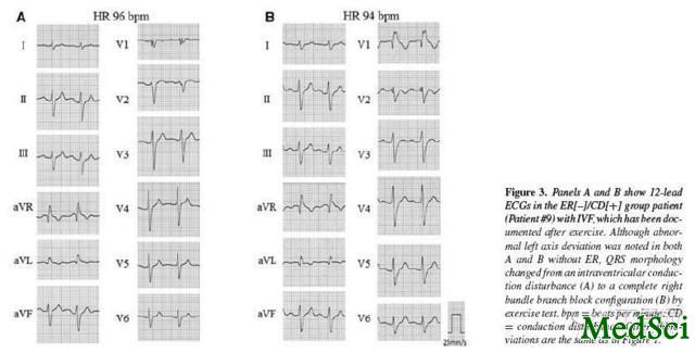 JCE：特发性室颤新的心电图特征