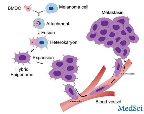 PLOS ONE:癌<font color="red">细胞</font>和<font color="red">白细胞</font>杂交可形成转移性肿瘤