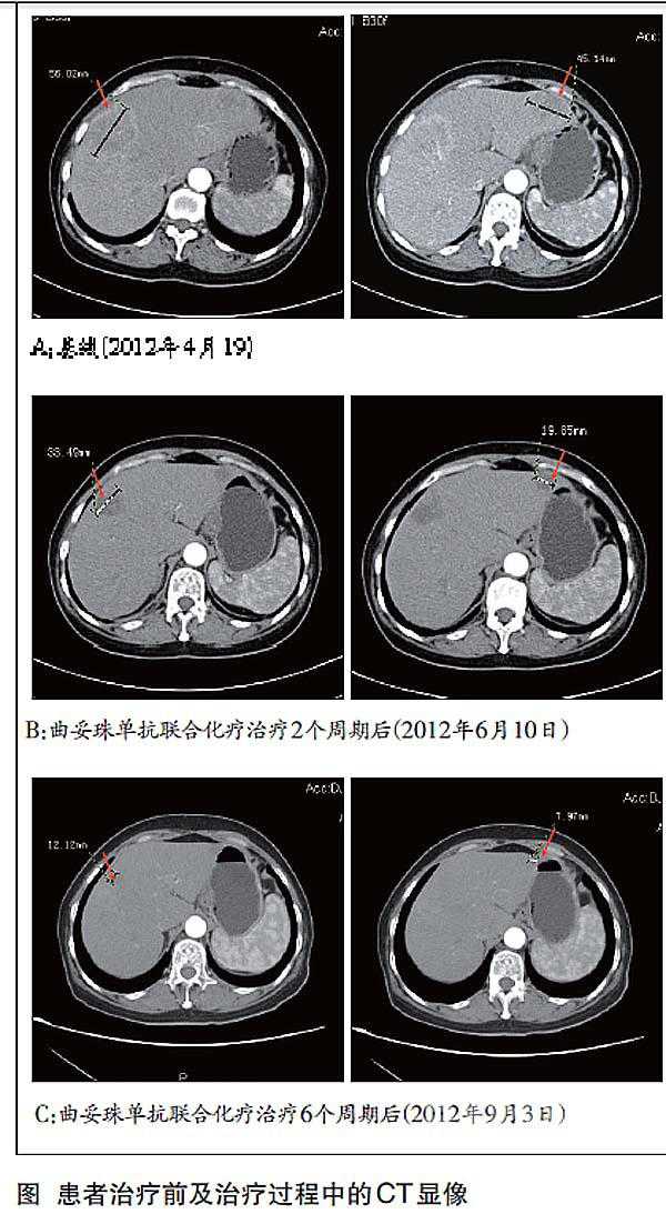 曲妥珠<font color="red">单抗</font>用于HER2阳性胃癌的治疗病例解析及思考