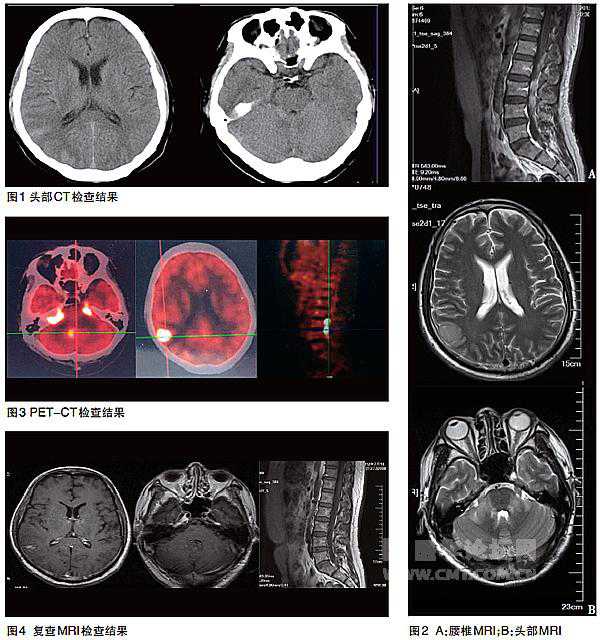 原发性中枢神经系统淋巴瘤（PCNSL）1例报道及病例分析