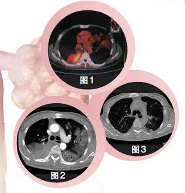 肺移植治疗肺癌<font color="red">的</font>经验分享
