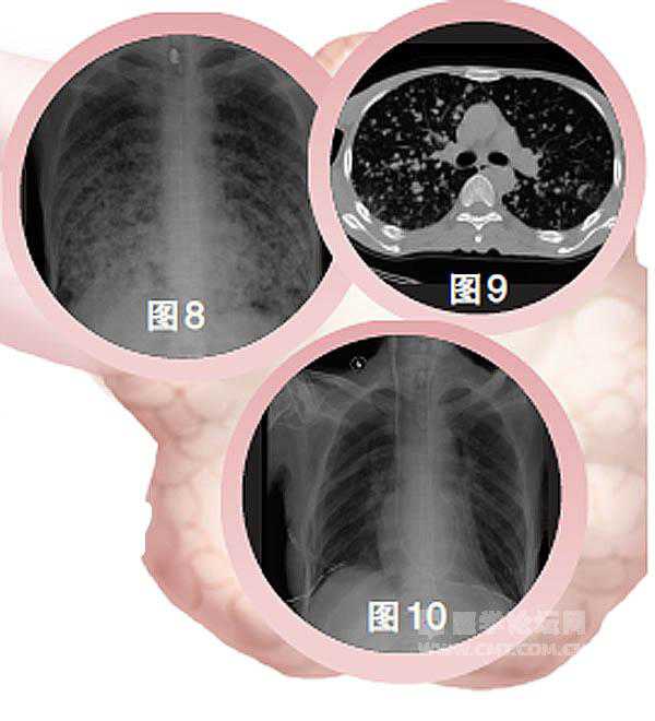 肺移植治疗肺癌案例集萃