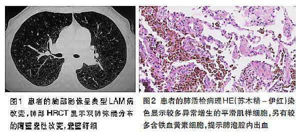 淋巴管肌瘤病：女性肺部<font color="red">弥漫性</font>囊性疾病