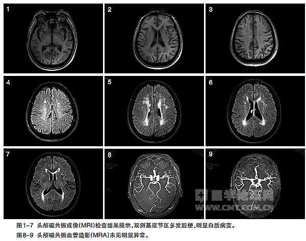 当心“脑供血不足”的陷阱