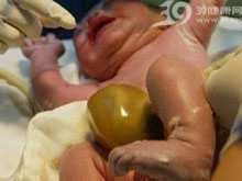 胎儿先天性腹壁缺损脏器膨出1例报道