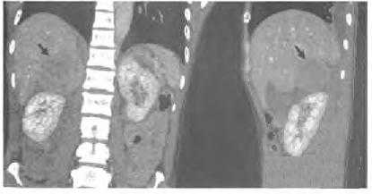 肾上腺嗜铬细胞瘤自发破裂一例