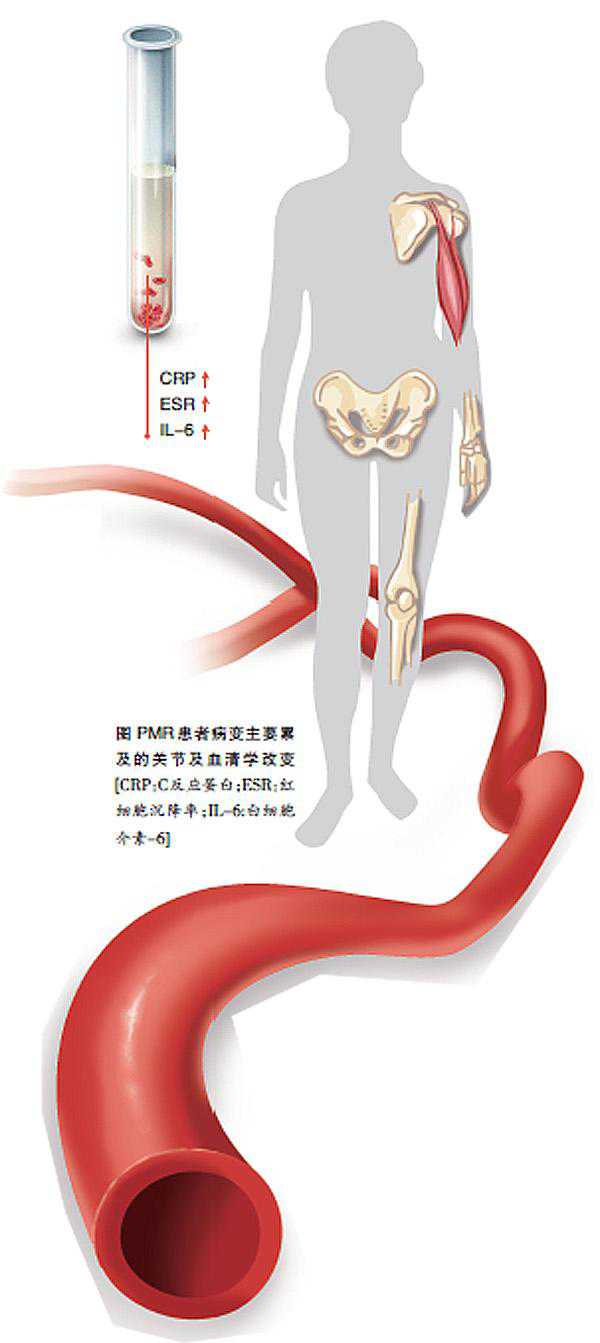 关注老年人严重肌痛病