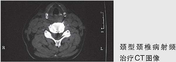射频热凝技术治疗颈型颈椎病1例报道及分析