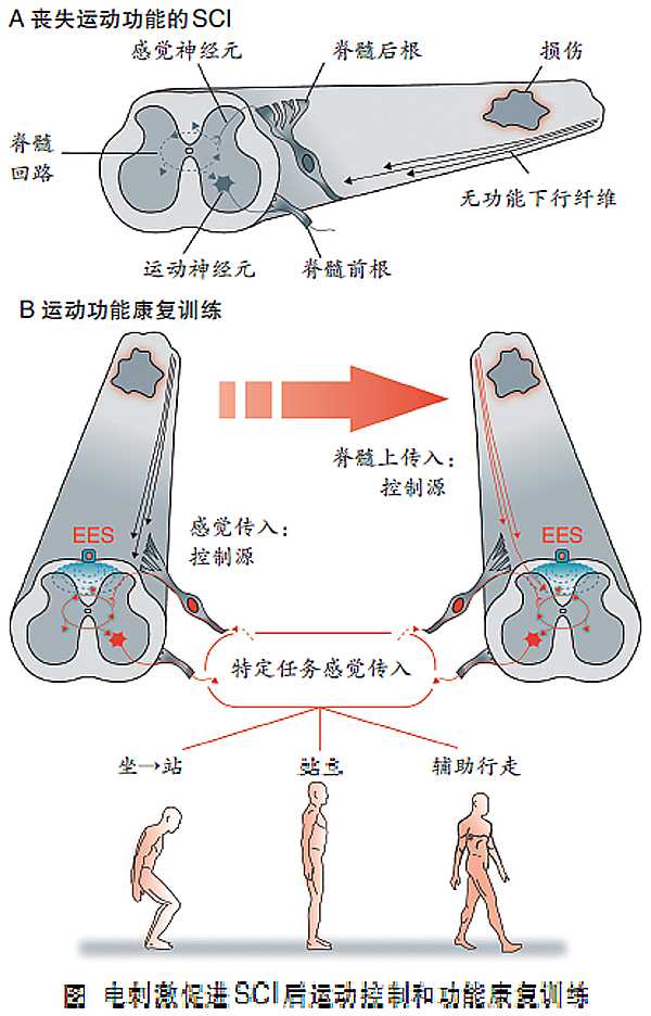 Lancet：硬膜外电刺激助力截瘫患者重新站起