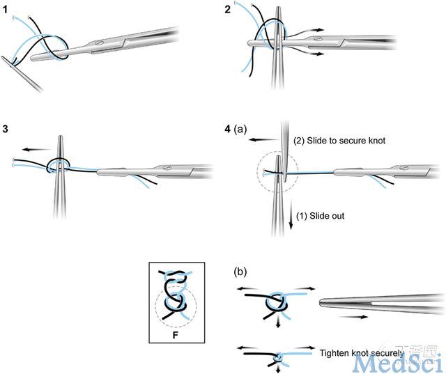 JBJS：一種新的手術(shù)打結(jié)方法——雙股單鎖結(jié)