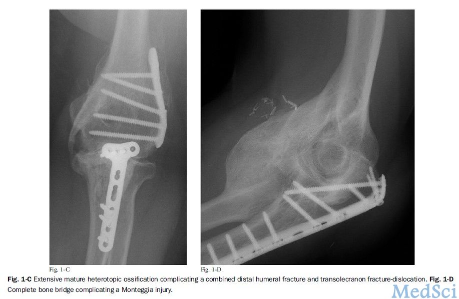Jbjs 尺桡骨近端骨折与骨折脱位术后的异位骨化 Medsci