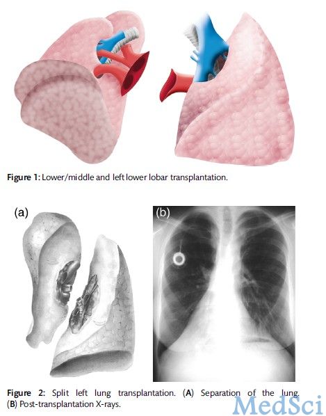 EJCS：肺叶移植术是一种可行的手术方式