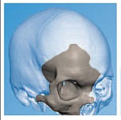 国内首次采用基于3D打印/<font color="red">CAD</font>技术-聚醚醚酮置入材料在颅颌骨缺损修复的临床应用