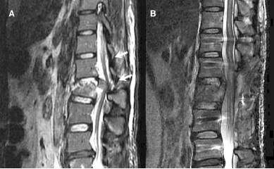 Spine：腰椎爆裂性骨折后路减压经硬膜囊修复马尾神经损伤