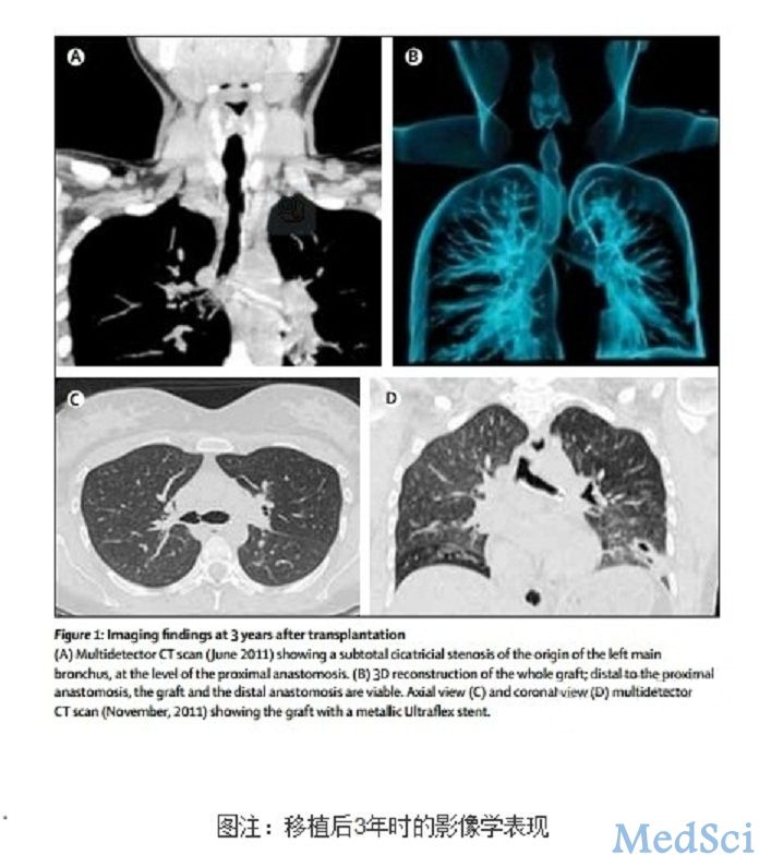 The Lancet：組織<font color="red">工程化</font>氣管移植術(shù)是一種安全且有前途的新技術(shù)