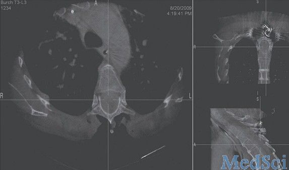 Spine：锥形束CT导航技术可减少医生的辐射暴露
