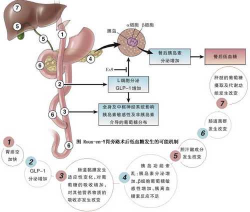 Gastroenterology：阻断GLP-1受体或可治疗胃旁路术后低血糖