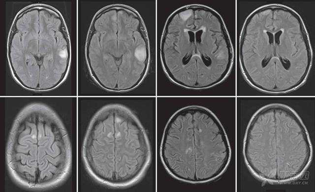 Lancet Neurol：<font color="red">抗</font>GABAA受体脑炎常伴癫痫持续状态
