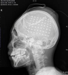 难治性癫痫颅内电极脑电图