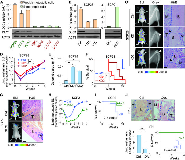 DLC1 suppresses breast cancer osteolytic metastasis.
(A) DLC1 expression...