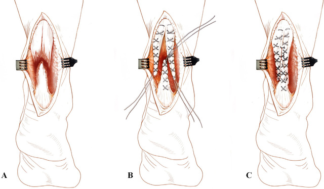 Injury：三束缝合法治疗急性跟腱断裂手术技术