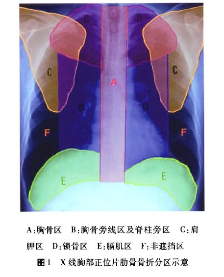 肋骨骨折分区对外科手术的指导意义