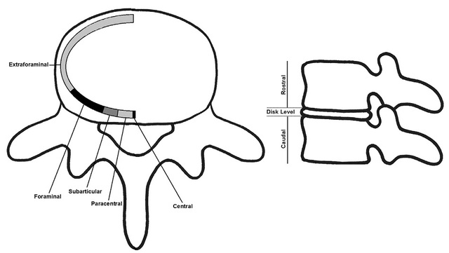 Spine J：椎间盘脱出时破出物在椎管内移动模式的大样本研究