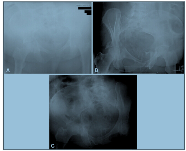 Clin Orthop Relat Res：二维CT对肥胖患者的髋臼骨折分型优于X线