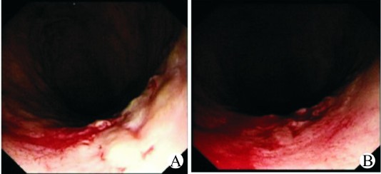 胃溃疡出血合并结肠闭合性憩室出血1例