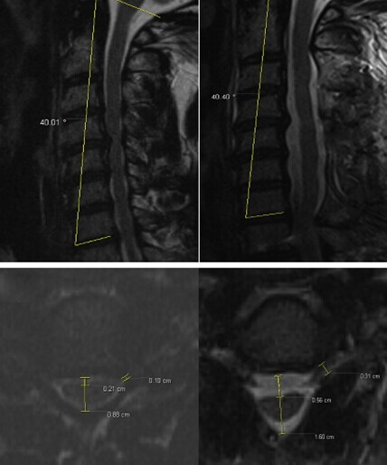 J Spinal Disord Tech：术中减压范围增大和脊髓后移可导致C5神经根麻痹