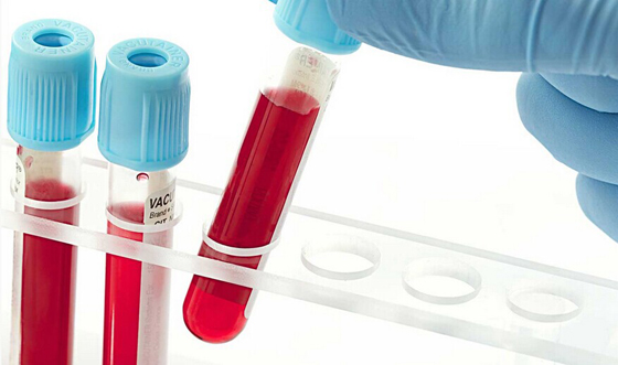 Diabetologia：哪种血型的人<font color="red">易</font>患糖尿病？