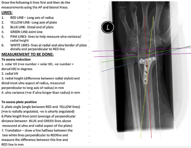 Injury：解剖<font color="red">复位</font>和正确摆放钢板位置能够降低拇长屈肌腱断裂