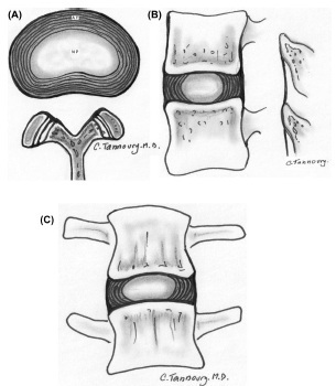 北美脊柱学会：腰椎间盘疾病第二版