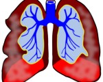 JACR：肺癌筛查评分系统<font color="red">Lung</font> <font color="red">RADS</font>公布