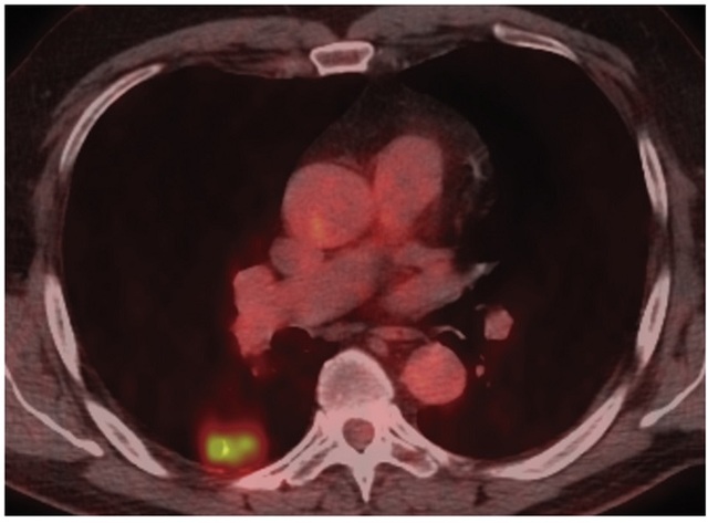 PET诊断早期肺癌N1<font color="red">淋巴结转</font>移准确性欠佳