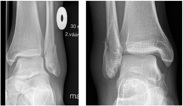 JBJS：MRI能准确评估旋后外旋型踝关节骨折的关节稳定性吗？