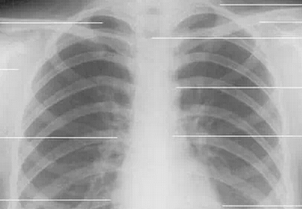 详尽的胸部CT影像示意图