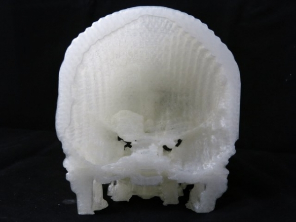 技术宅用3D打印帮妻子治疗脑瘤