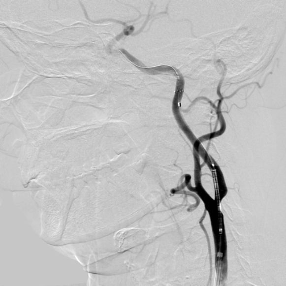 JAMA Neurol：颈动脉支架置入术风险与获益