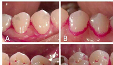 BMC Oral Health：灭菌光动力疗法抑制健康成人<font color="red">牙菌斑</font>的形成
