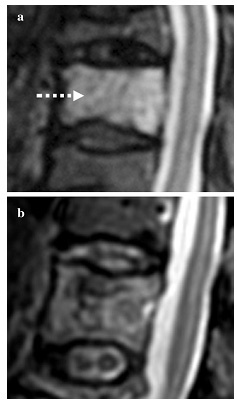 Eur Spine J：短反转时间反转恢复MRI可预判骨质疏松骨折椎体预后