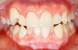 BMC Oral Health：错颌畸形患病率及其与12-18岁残疾青少年龋病之间的关系