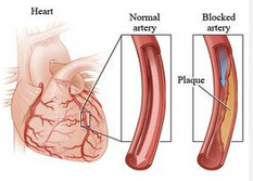 NEJM：膽固醇<font color="red">流出</font>能力或可預(yù)測(cè)心臟病風(fēng)險(xiǎn)