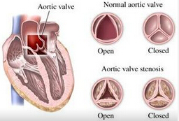 Heart：TAVR可改善不能手术的严重主动脉狭窄患者生存
