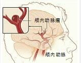 Stroke：颅内动脉瘤<font color="red">遗传</font><font color="red">倾向</font>正趋于明朗