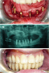BMC Oral Health：口腔癌患者术后牙种植体的存活率低
