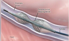 NEJM：冠状窦缩小装置可使难治性心绞痛患者获益